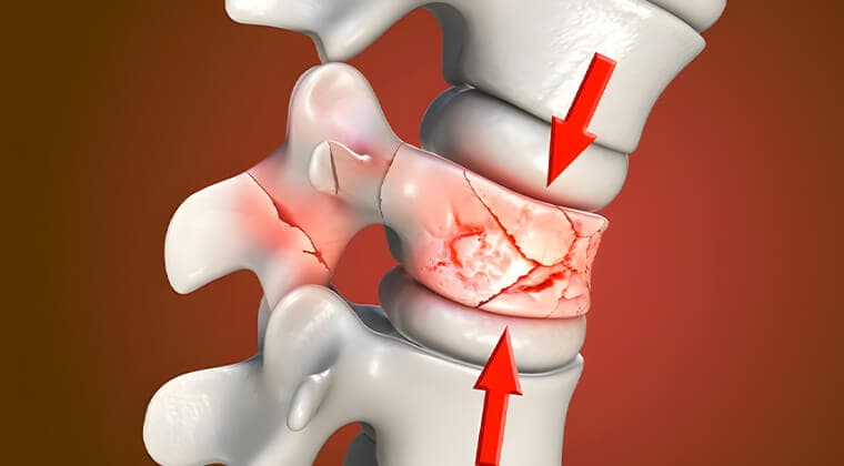 Fractura de columna vertebral