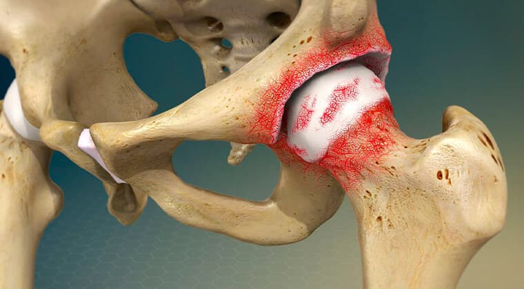 Osteoartritis de Cadera