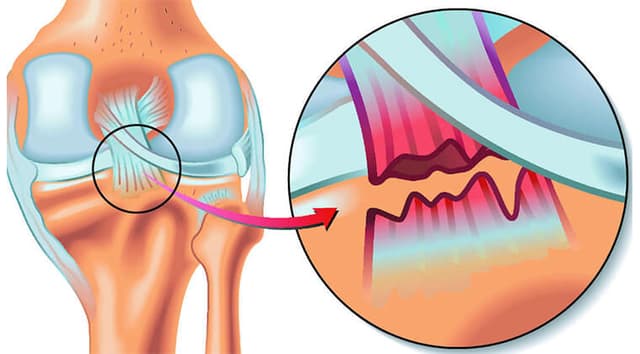 Ruptura de ligamento cruzado anterior