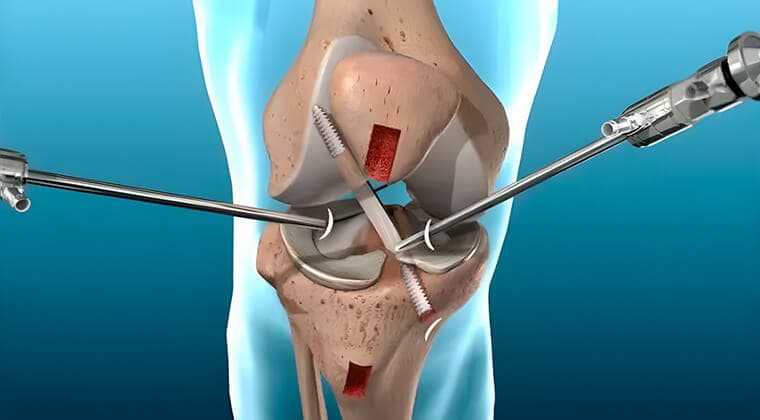 Artroscopia de rodilla