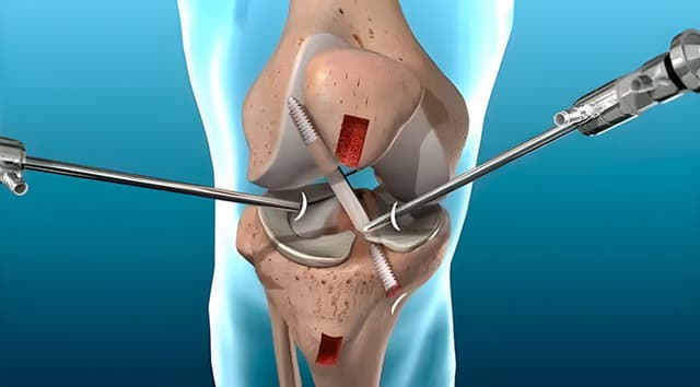 Artroscopia de rodilla
