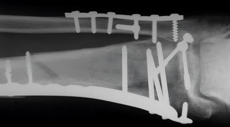 Osteosíntesis (fijación quirúrgica de fracturas)