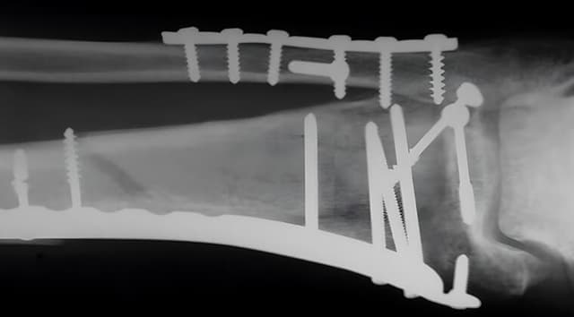 Osteosíntesis (fijación quirúrgica de fracturas)