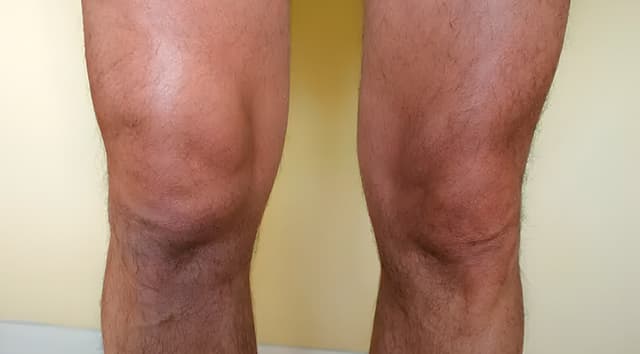 Inflamación o edema en la zona afectada